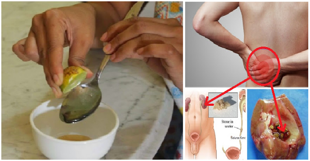 Ternyata Hanya Dengan Lemon dan Minyak Zaitun Batu Ginjal Ternyata Hanya Dengan Lemon dan Minyak Zaitun Batu Ginjal
