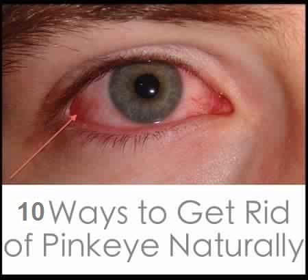 what can i get over the counter for pink eye