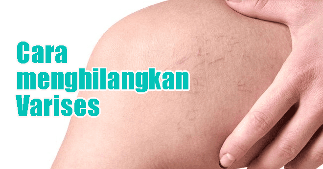 Bagaimana Cara Menghilangkan Varises Pada Kaki Bagaimana Cara Menghilangkan Varises Pada Kaki