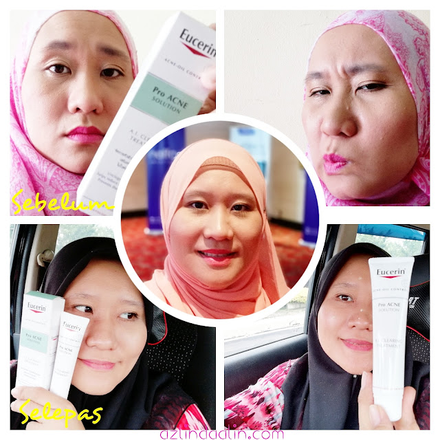 SAY NO TO JERAWAT ! Eucerin® ProACNEa A.I Clearing Treatment 14 Days Challenge