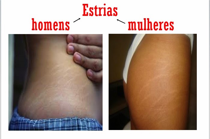 Estrias-em-homens-e-mulheres