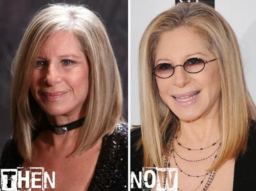 Barbra Streisand Plastic Surgery Before and After Botox Injections and Nose Job Photos