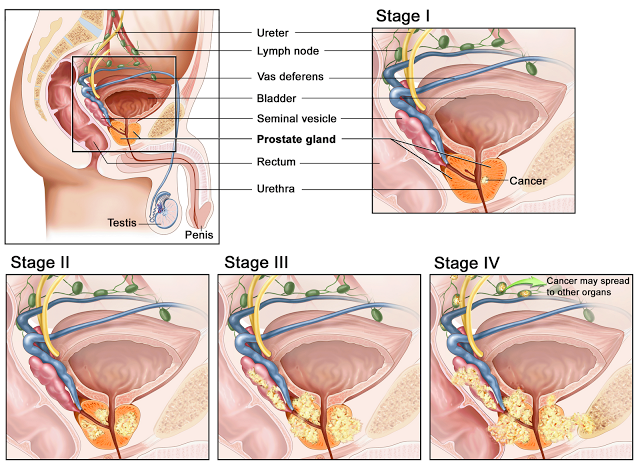 Stage of Prostate Cancer