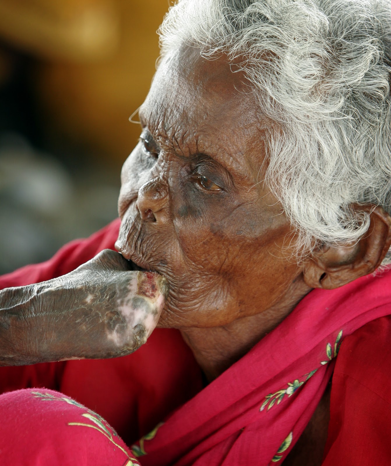 World Leprosy Day - Be the Change