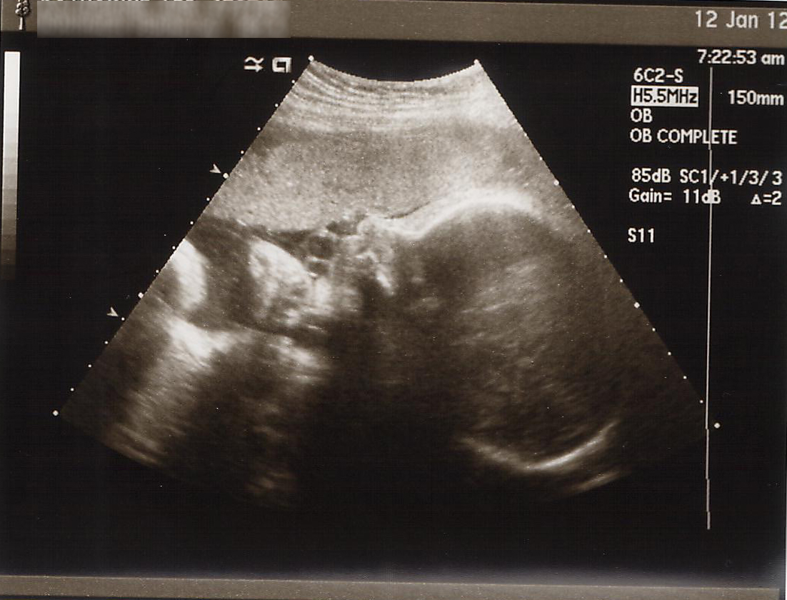 32 week ultrasound Mom in Leggings