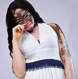 Historia sobre el vitiligo