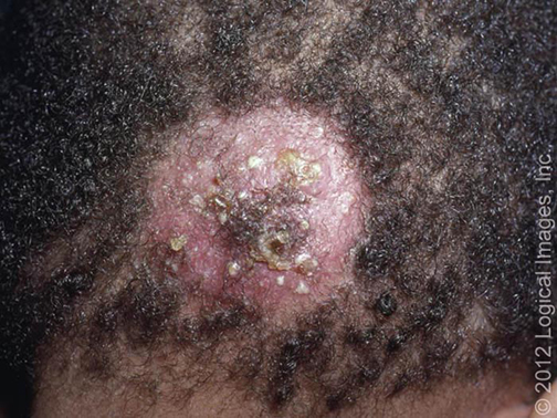 Symptoms And Treatment Of Alopecia Areata