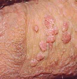 Jual Obat Kutil Kelamin Di Kalimantan Utara