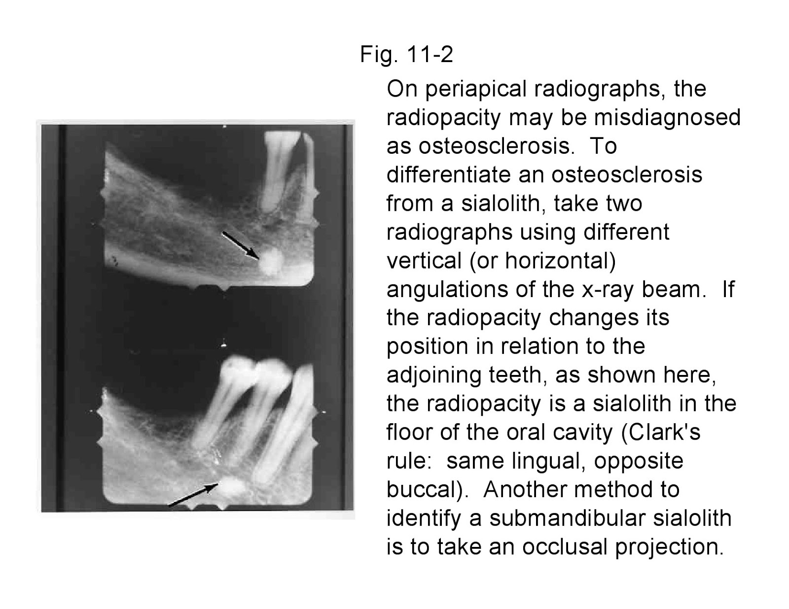 Calcified Plaque Teeth _ Tartar (Dental Calculus): 6 Tips to Remove ...