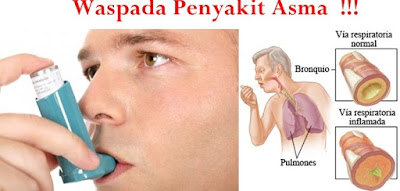 Ramuan untuk penyakit asma