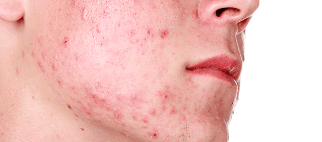 remedios contra el acné