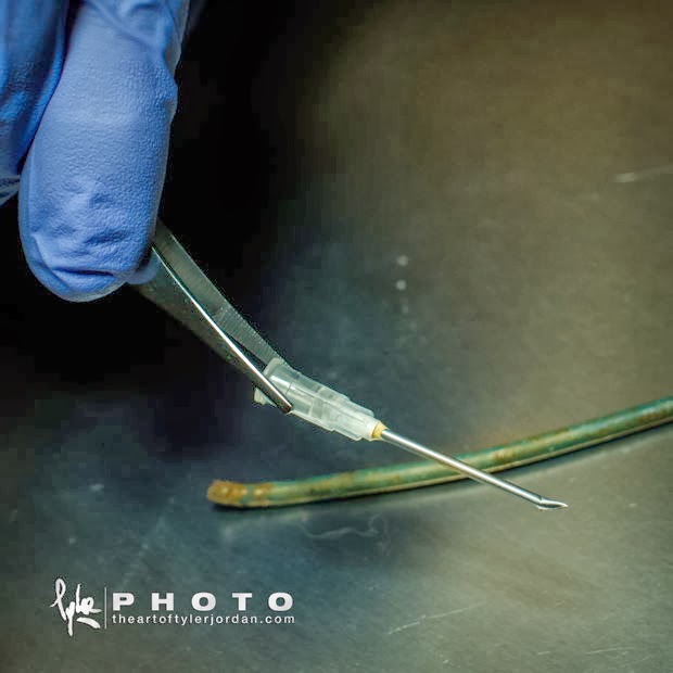 Objetos extraidos del pene de una persona por un Urologo