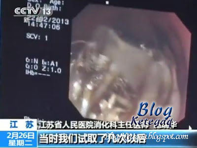 Ketulan rambut ditemui di dalam perut seorang gadis China