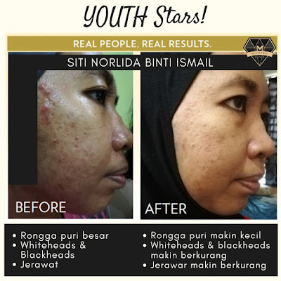 TESTIMONI YOUTH SKINCARE: PEMENANG PERTANDINGAN YOUTH STAR 