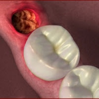 Complications d'élimination des dents de sagesse