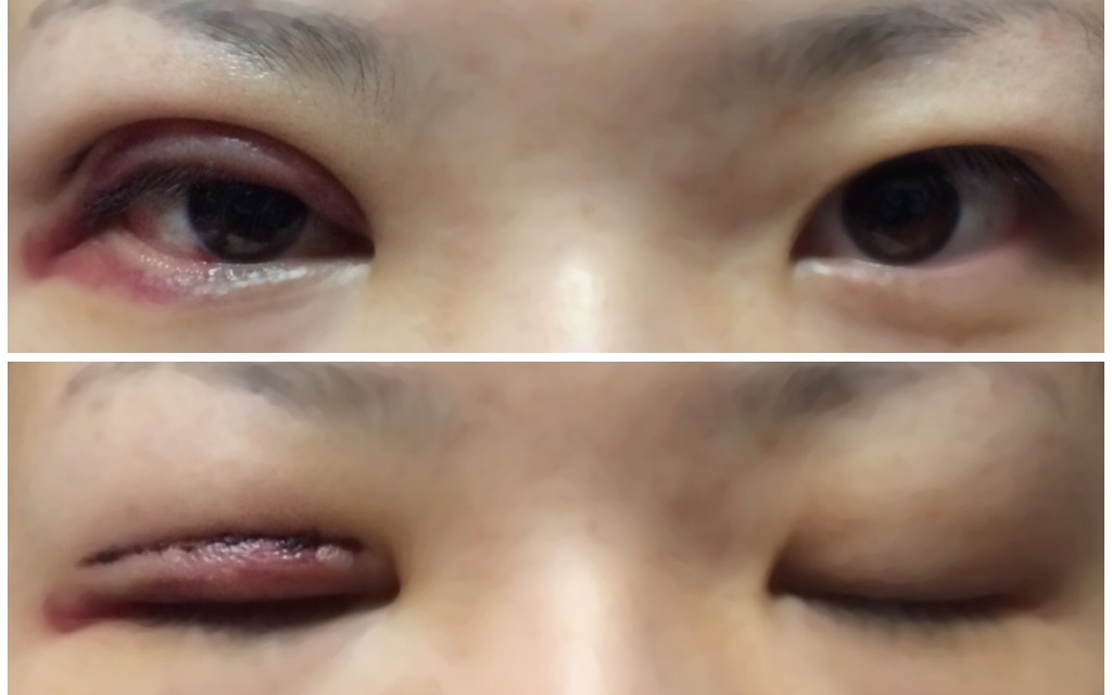 二重（ふたえ）全切開手術 手術後2日 二重(ふたえ）整形、全切開への道