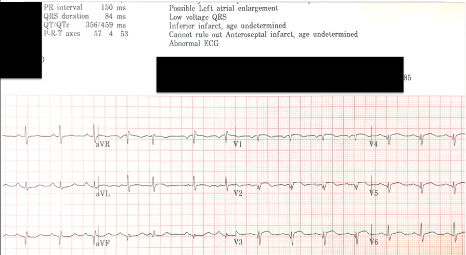Dr. Smith's ECG Blog Anterorlateral STEMI? Old Anterior MI? But cath