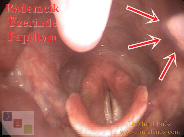 Bademcik papillomu - Bademcik üzerinde siğil - Boğazda siğil - Ağızda HPV enfeksiyonu - Bademcik papillomu foto