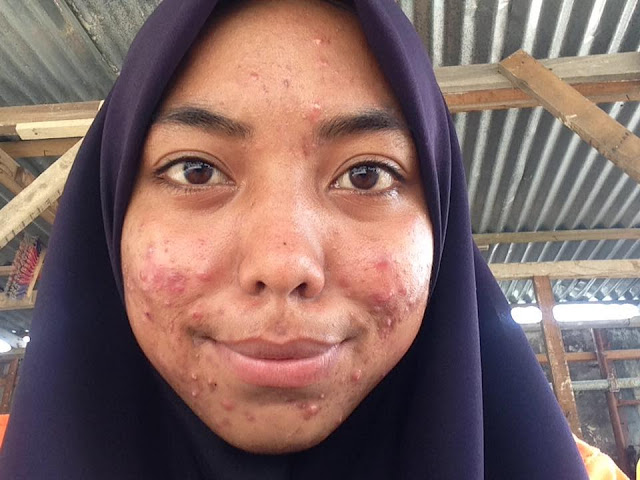 Ubat Jerawat Batu Berkesan  Beninbns