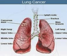 pengobatan tradisional tumor Paru paru, obat kanker paru, pengobatan kanker paru