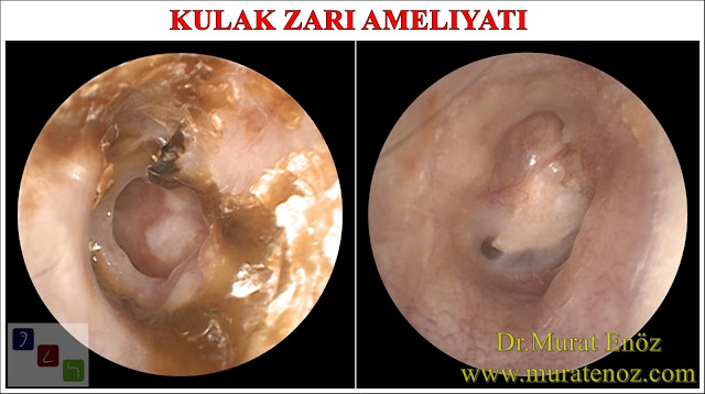 Eardrum repair  in Istanbul - Eardrum hole repair - Tympanic membrane repair  in Istanbul - Myringoplasty in Istanbul - Tympanoplasty in Istanbul
