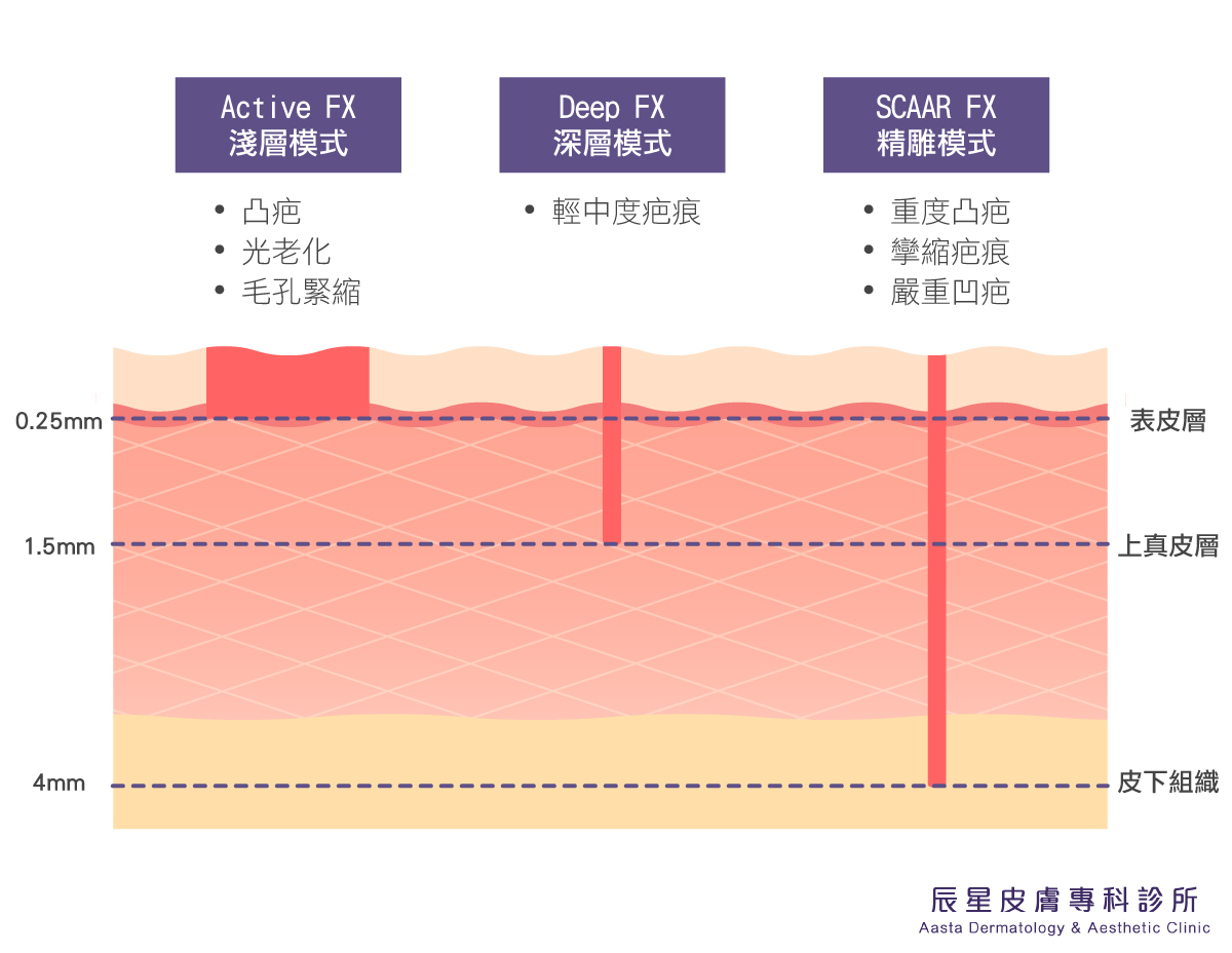 UP雷射疤痕UP雷射UP雷射疤痕UP雷射台北UP雷射疤痕推薦台北UP雷射疤痕台北up雷射內湖up雷射推薦內湖UP雷射內湖up雷射內湖UP雷射推薦台北皮膚科推薦皮膚科內湖皮膚科推薦內湖皮膚科治療凹疤凹疤治療治療痘疤痘疤治療治療疤痕疤痕治療雷射毛孔治療毛孔毛孔治療雷射凹疤凹疤雷射雷射痘疤痘疤雷射雷射疤痕疤痕雷射UP雷射治療凹疤UP雷射治療痘疤UP雷射治療疤痕up雷射治療疤痕up雷射治療痘疤up雷射治療凹疤UP雷射凹疤UP雷射痘疤UP雷射疤痕UP雷射毛孔up雷射凹疤up雷射痘疤up雷射疤痕up雷射毛孔up雷射恢復期up雷射副作用up雷射反黑up雷射價錢up雷射費用UP雷射恢復期UP雷射副作用反黑UP雷射價錢UP雷射費用up雷射價格pttup雷射修復期ultrapulseup雷射dcardUP雷射dcardup雷射維格up雷射台北up雷射修復期up雷射心得up雷射高雄ultrapulse雷射價錢up雷射台南ultrapulse雷射痘疤ultrapulse雷射台中up雷射美上美up雷射費用up雷射價格up雷射台中up雷射pttup雷射價錢up雷射維格ultrapulse雷射價格up雷射痘疤up雷射台北ultra pulse雷射價格ultrapulse恢復期up雷射恢復期up雷射推薦up雷射up雷射凹疤up雷射痘疤up雷射疤痕UP雷射UP雷射凹疤UP雷射痘疤up雷射費用up雷射價格up雷射台北up雷射痛up雷射痘疤up雷射修復期凹疤修復凹疤藥膏凹疤ptt凹疤雷射凹洞治療費用植凹疤蜂巢皮秒凹疤臉上凹洞怎麼辦痘疤凹洞價錢痘疤凹洞消除痘疤消除痘疤淡化痘疤黑色素沉澱痘疤保養品去痘疤產品痘疤ptt痘疤藥膏紅痘疤怎麼消黑色痘疤色素痘疤辰星皮膚專科診所評價辰星皮膚專科診所ptt辰星皮膚科ptt辰星皮膚科掛號費辰星皮膚ptt港墘皮膚科內湖皮膚科推薦楊兆傑醫師 UP雷射疤痕UP雷射UP雷射疤痕UP雷射台北UP雷射疤痕推薦台北UP雷射疤痕台北up雷射內湖up雷射推薦內湖UP雷射內湖up雷射內湖UP雷射推薦台北皮膚科推薦皮膚科內湖皮膚科推薦內湖皮膚科治療凹疤凹疤治療治療痘疤痘疤治療治療疤痕疤痕治療雷射毛孔治療毛孔毛孔治療雷射凹疤凹疤雷射雷射痘疤痘疤雷射雷射疤痕疤痕雷射UP雷射治療凹疤UP雷射治療痘疤UP雷射治療疤痕up雷射治療疤痕up雷射治療痘疤up雷射治療凹疤UP雷射凹疤UP雷射痘疤UP雷射疤痕UP雷射毛孔up雷射凹疤up雷射痘疤up雷射疤痕up雷射毛孔up雷射恢復期up雷射副作用up雷射反黑up雷射價錢up雷射費用UP雷射恢復期UP雷射副作用反黑UP雷射價錢UP雷射費用up雷射價格pttup雷射修復期ultrapulseup雷射dcardUP雷射dcardup雷射維格up雷射台北up雷射修復期up雷射心得up雷射高雄ultrapulse雷射價錢up雷射台南ultrapulse雷射痘疤ultrapulse雷射台中up雷射美上美up雷射費用up雷射價格up雷射台中up雷射pttup雷射價錢up雷射維格ultrapulse雷射價格up雷射痘疤up雷射台北ultra pulse雷射價格ultrapulse恢復期up雷射恢復期up雷射推薦up雷射up雷射凹疤up雷射痘疤up雷射疤痕UP雷射UP雷射凹疤UP雷射痘疤up雷射費用up雷射價格up雷射台北up雷射痛up雷射痘疤up雷射修復期凹疤修復凹疤藥膏凹疤ptt凹疤雷射凹洞治療費用植凹疤蜂巢皮秒凹疤臉上凹洞怎麼辦痘疤凹洞價錢痘疤凹洞消除痘疤消除痘疤淡化痘疤黑色素沉澱痘疤保養品去痘疤產品痘疤ptt痘疤藥膏紅痘疤怎麼消黑色痘疤色素痘疤辰星皮膚專科診所評價辰星皮膚專科診所ptt辰星皮膚科ptt辰星皮膚科掛號費辰星皮膚ptt港墘皮膚科內湖皮膚科推薦楊兆傑醫師