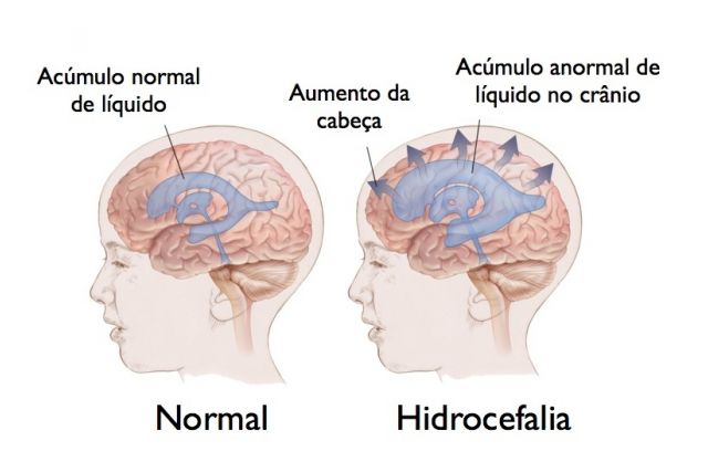 Neuropediatria em foco: O que é hidrocefalia?