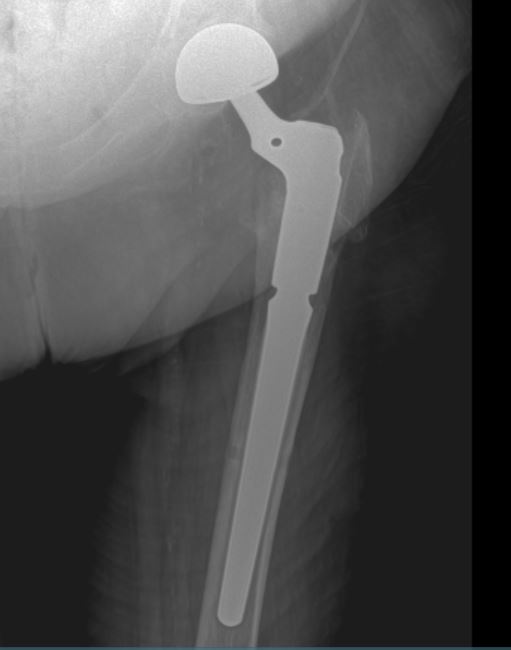 Interesting Topics in Orthopedic Surgery by Dr. Nasar Failed fixation