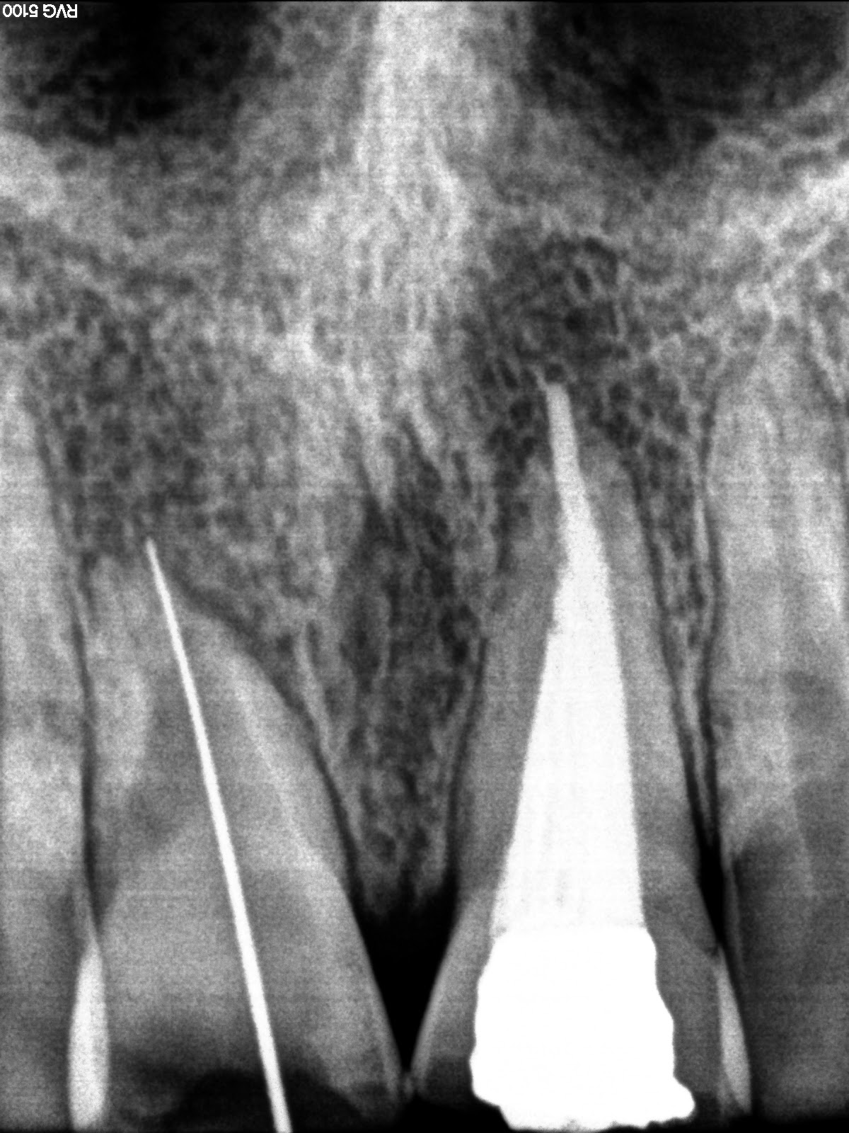 Endodontics Obturation with tooth having internal resorption.