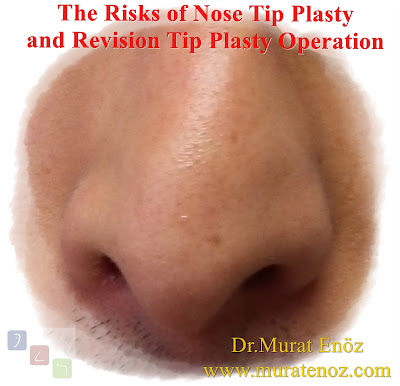 Risks and complications in nose tip plasty - The possible risks and complications for nasal tip plasty - Revision tip plasty operation in İstanbul - Revision tip plasty operation in Turkey - Revision nasal tip rhinoplasty in İstanbul - Cosmetic surgery of the nasal tip in İstanbul
