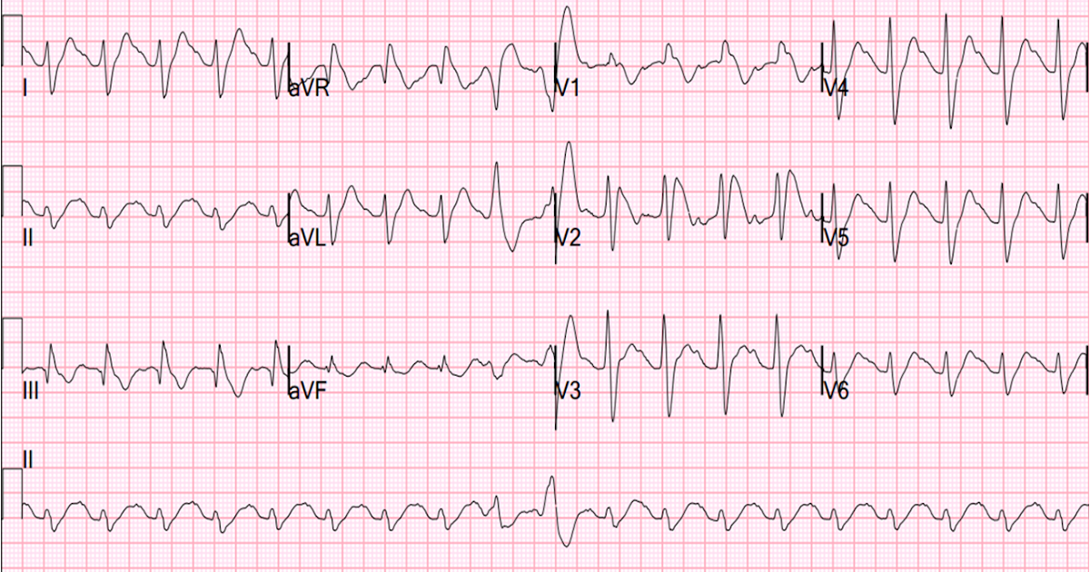 dr-smith-s-ecg-blog-brugada-pattern-induced-by-tricyclic-antidepressant