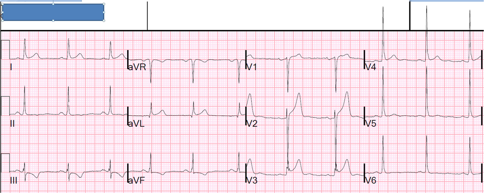 Dr. Smith's ECG Blog 4 Cases Discussing Terminal QRS Distortion in
