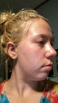 Young Living Essential Oil Acne treatment www.sewplus.blogspot.com