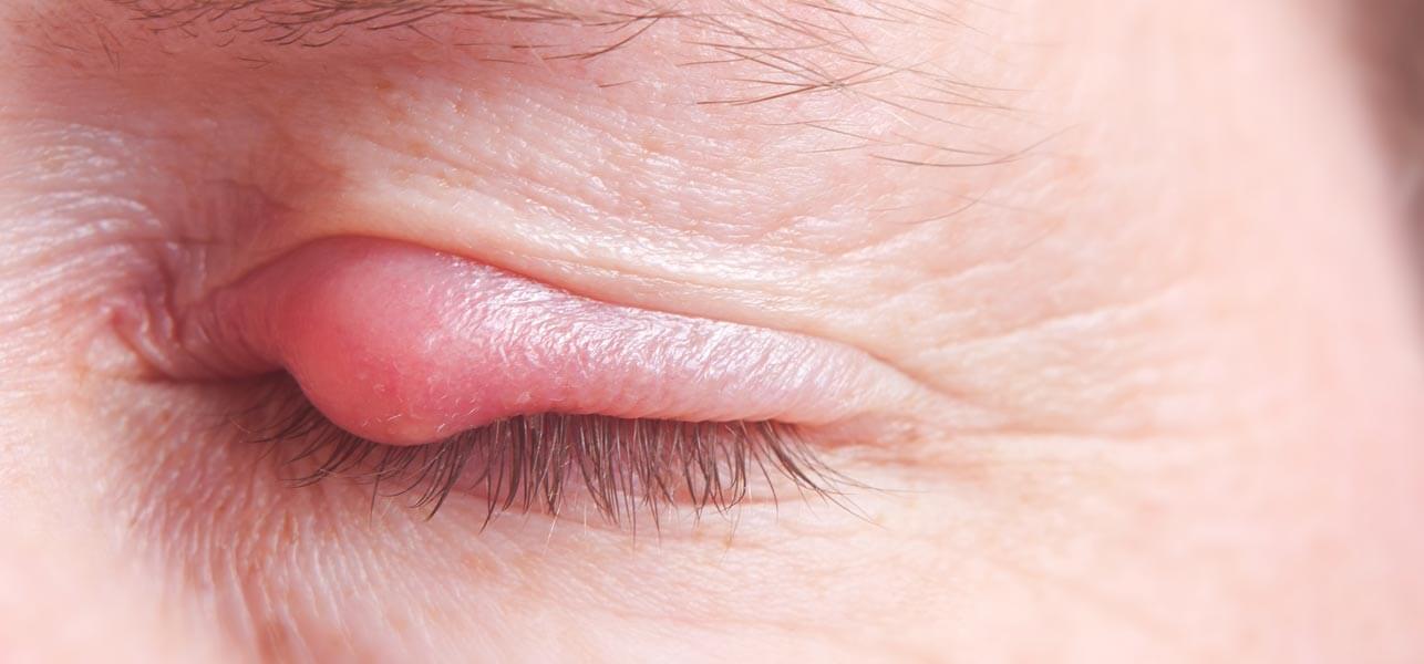 How To Remove Pimples On Eyelids? Family Health Articles