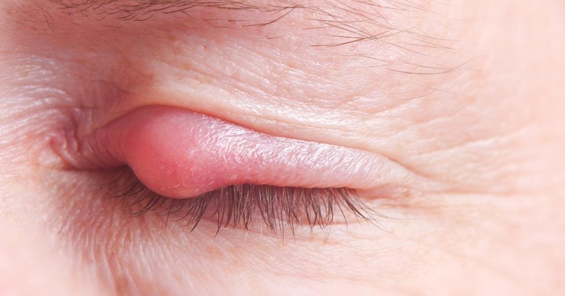 how-to-remove-pimples-on-eyelids-family-health-articles