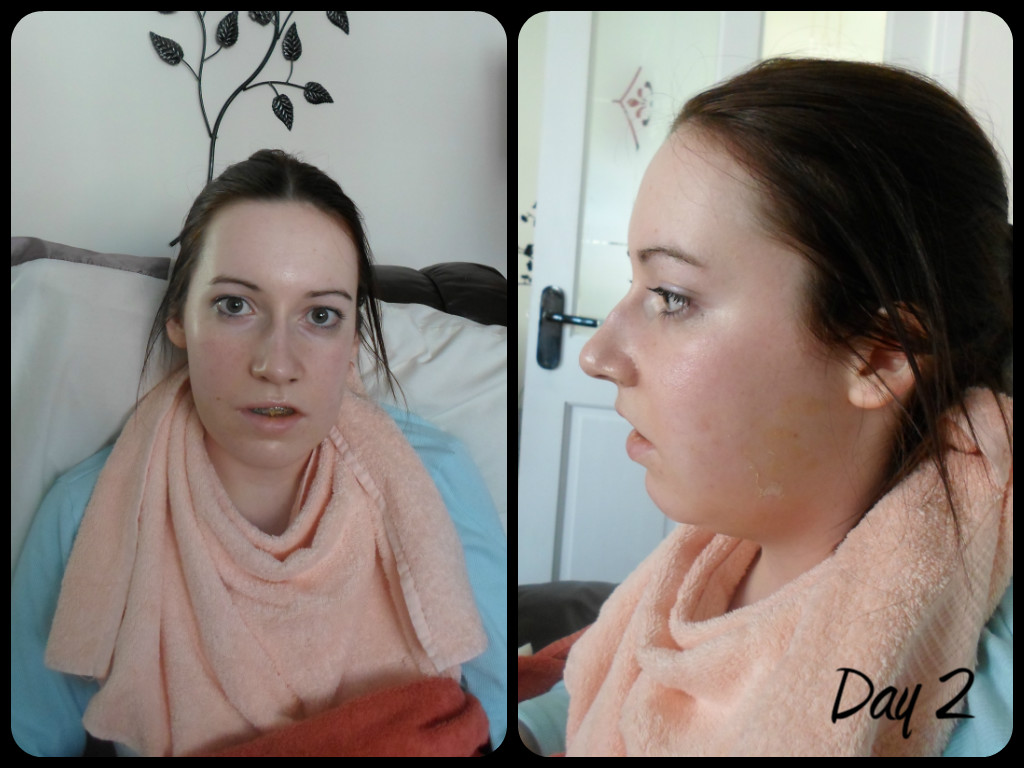 My jaw surgery and I.. Day 2 Overview