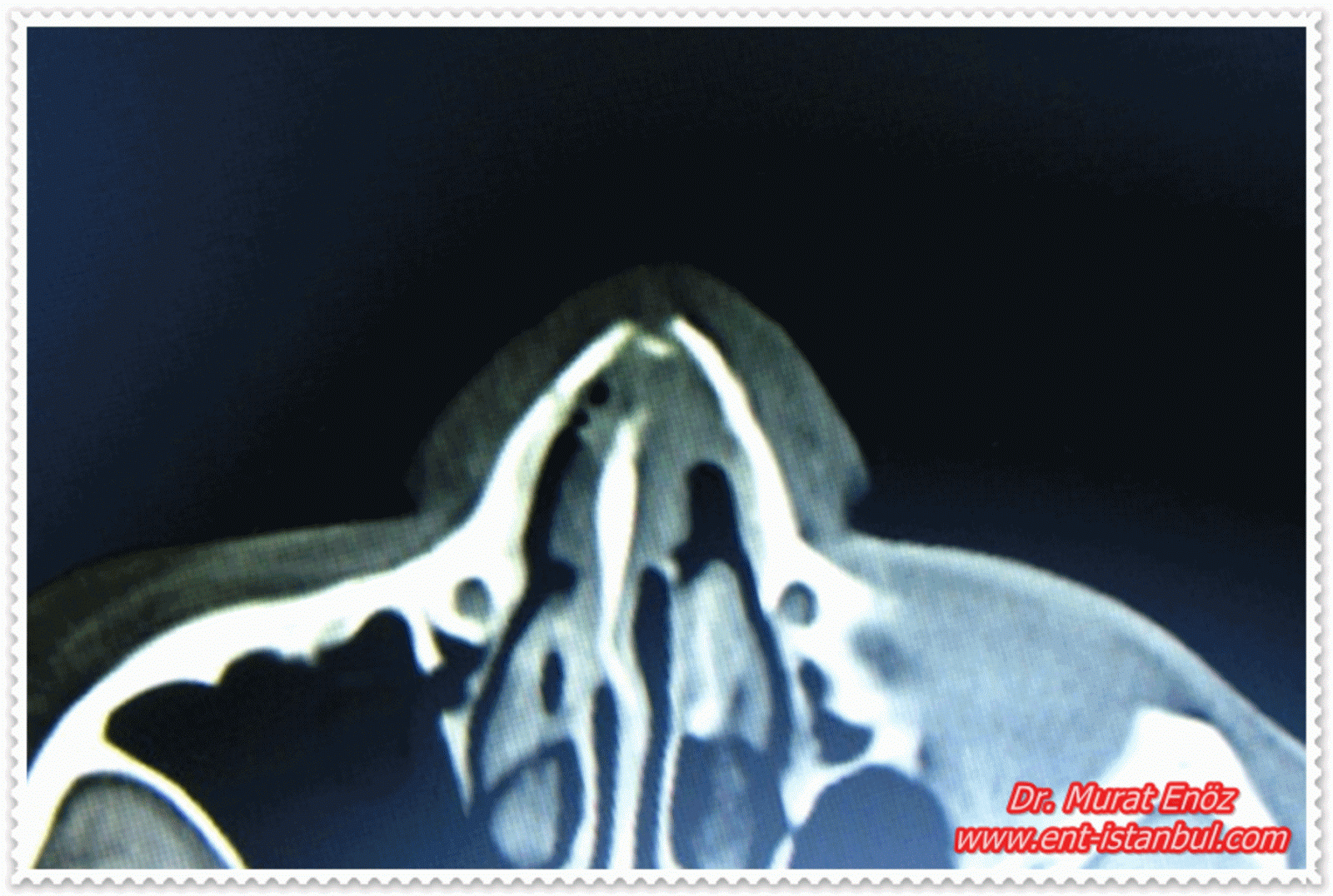 Nasal Fractures Causes, Symptoms, Diagnosis, Treatment