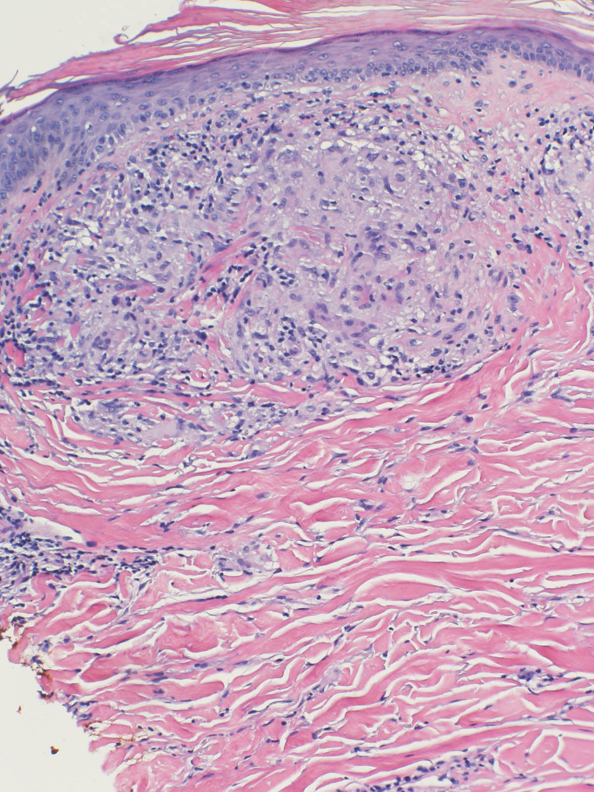 Chronic lymphocytic inflammation with pontine perivascular ...