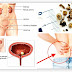 obat kencing batu herbal