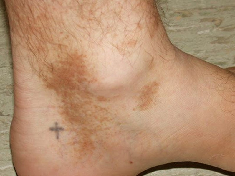 brown spots on ankles