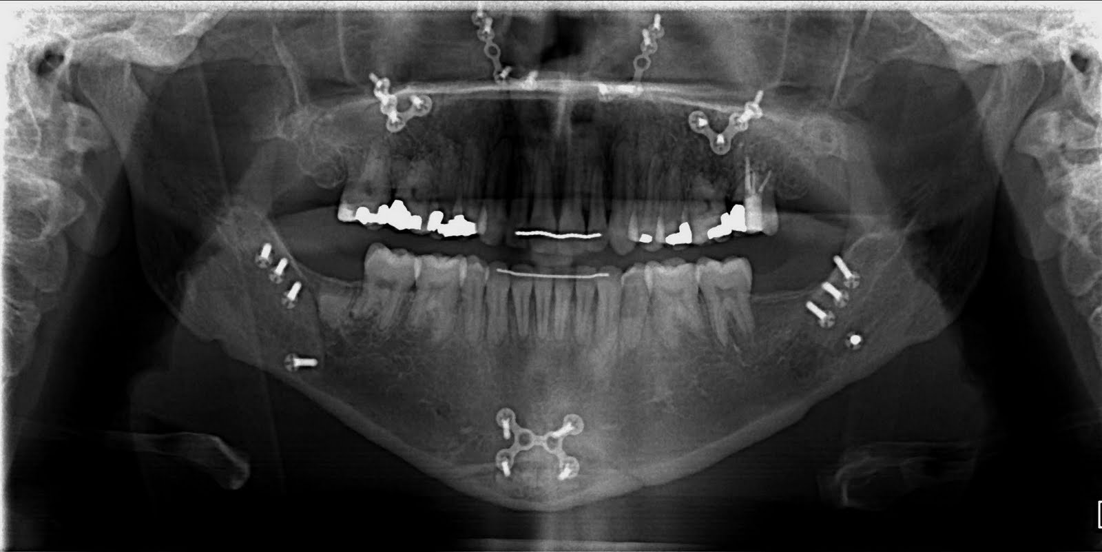 steph's jaw surgery blog xrays