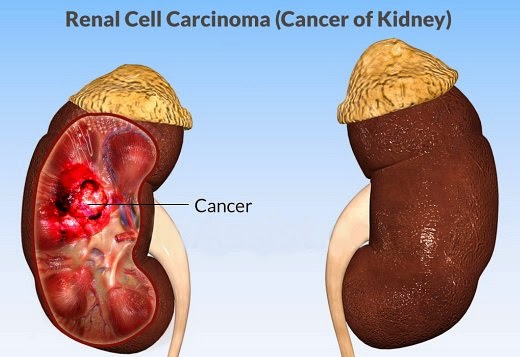 Kidney Cancer, Renal Cell Carcinoma