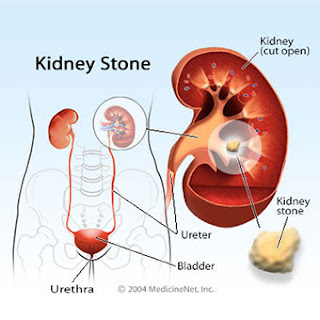 Was Sie Steine ​​Kidney Wie fühlen?