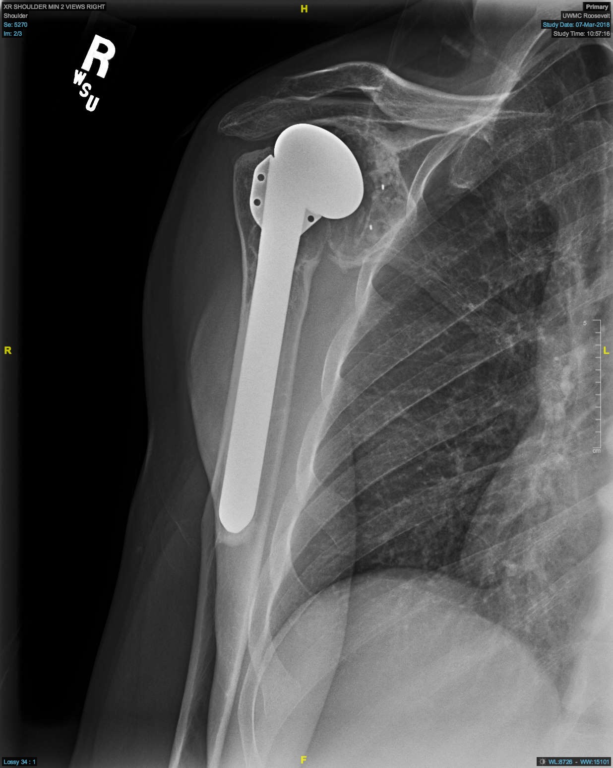 Shoulder Arthritis/Joint Replacement Rotator cuff tears Shoulder replacement complications