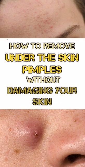 How to remove under the skin pimples without damaging your skin