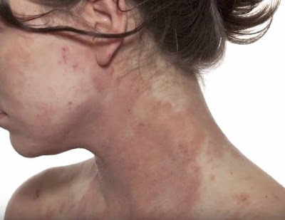 Eczema Symptoms