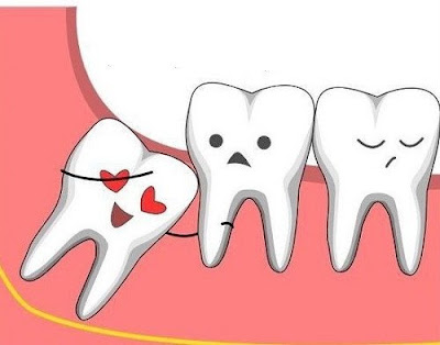  Nhổ răng khôn nên kiêng những gì?