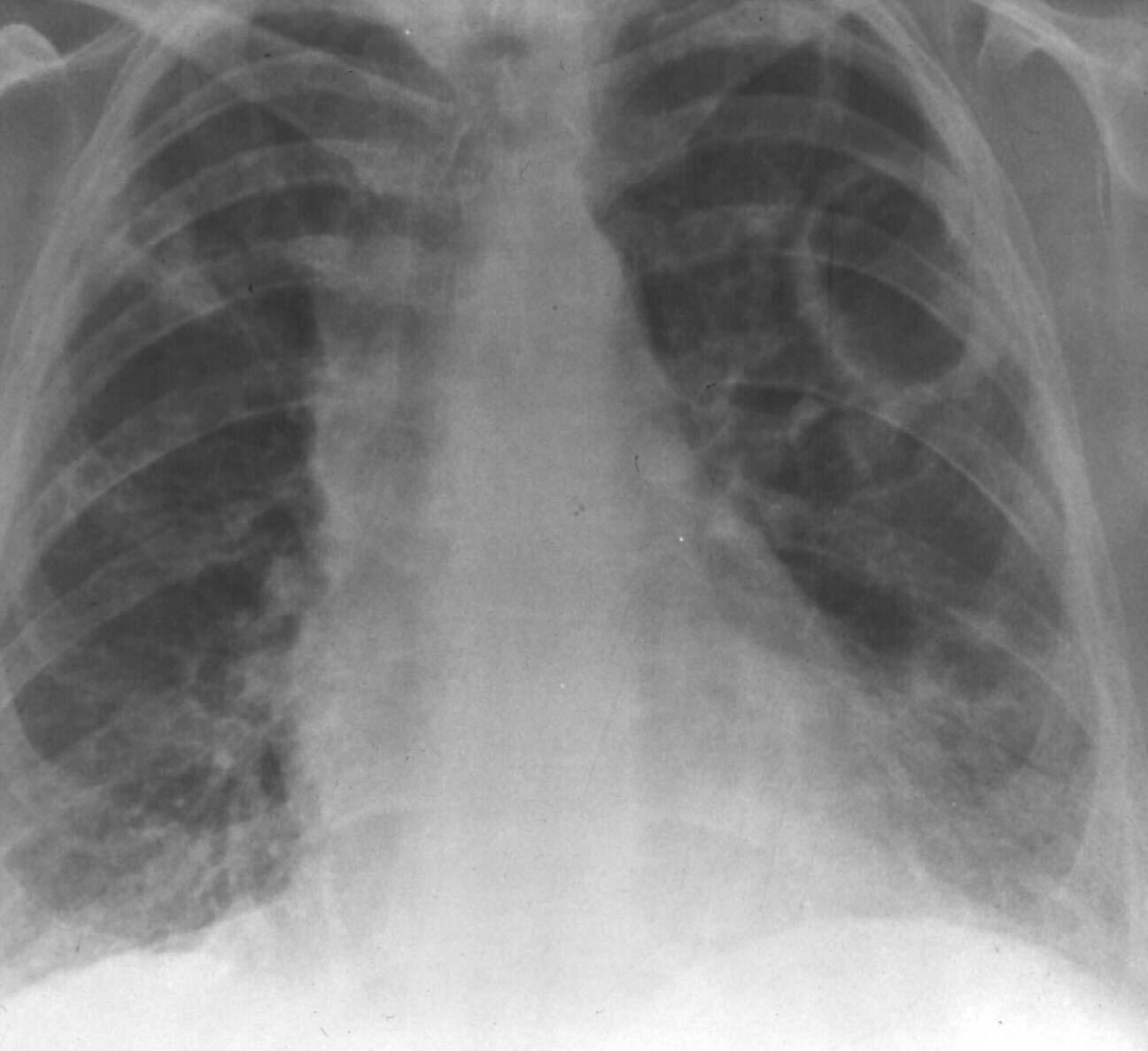 Prezentari Medicale Afectarea pulmonara in granulomatoza cu