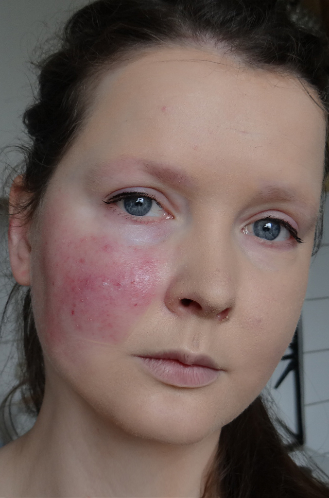 Scarlet Letters, dealing with vascular rosacea, face flushing, burning