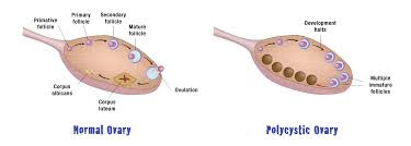 Polycystic Ovary Syndrome Surgery